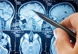 Traumatic Brain Injury Cases